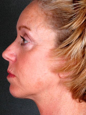 e-lift - patient 5542 - after 3 e-lift - patient 5542 - after 3