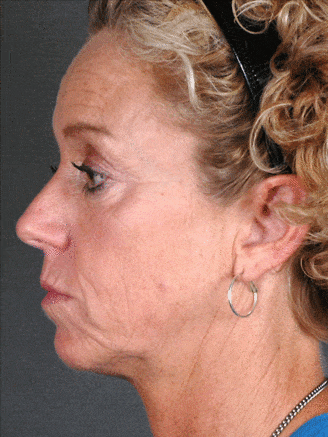 browlift - patient 5522 - before 3 browlift - patient 5522 - before 3