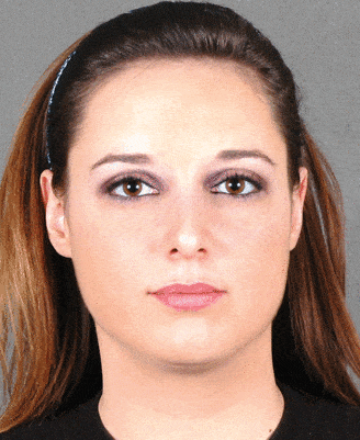 rhinoplasty - patient 5776 - after 1 rhinoplasty - patient 5776 - after 1