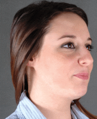 rhinoplasty - patient 5776 - before 2 rhinoplasty - patient 5776 - before 2