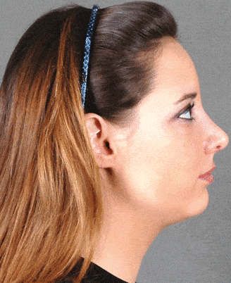 rhinoplasty - patient 5776 - after 3 rhinoplasty - patient 5776 - after 3
