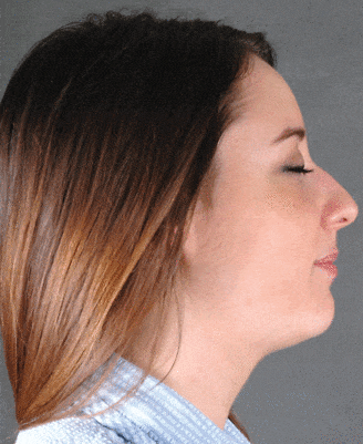 rhinoplasty - patient 5776 - before 3 rhinoplasty - patient 5776 - before 3