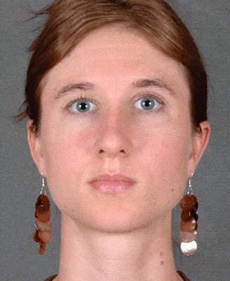 rhinoplasty - patient 5798 - after 1 rhinoplasty - patient 5798 - after 1
