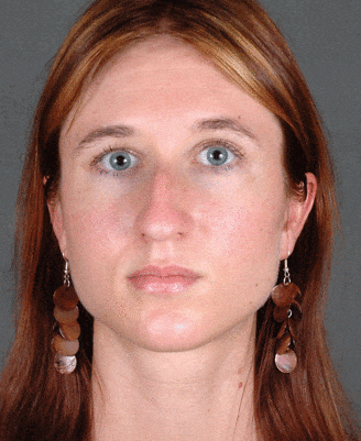 rhinoplasty - patient 5798 - before 1 rhinoplasty - patient 5798 - before 1