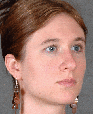 rhinoplasty - patient 5798 - after 2 rhinoplasty - patient 5798 - after 2
