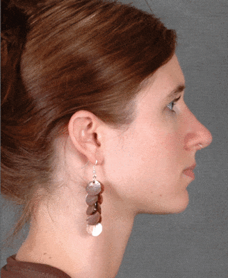 rhinoplasty - patient 5798 - after 3 rhinoplasty - patient 5798 - after 3