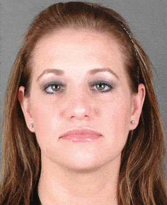 rhinoplasty - patient 5925 - after 1 rhinoplasty - patient 5925 - after 1