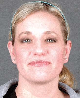 rhinoplasty - patient 5925 - before 1 rhinoplasty - patient 5925 - before 1