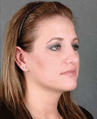 rhinoplasty - patient 5925 - after 2 rhinoplasty - patient 5925 - after 2