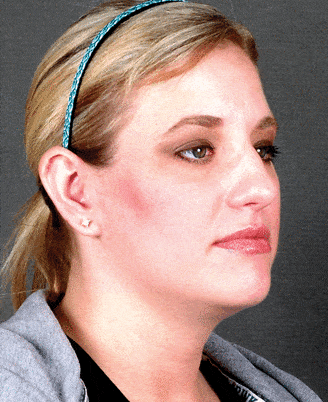 rhinoplasty - patient 5925 - before 2 rhinoplasty - patient 5925 - before 2