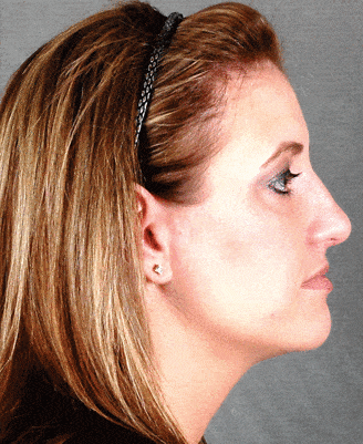 rhinoplasty - patient 5925 - after 3 rhinoplasty - patient 5925 - after 3