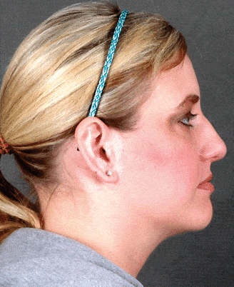 rhinoplasty - patient 5925 - before 3 rhinoplasty - patient 5925 - before 3