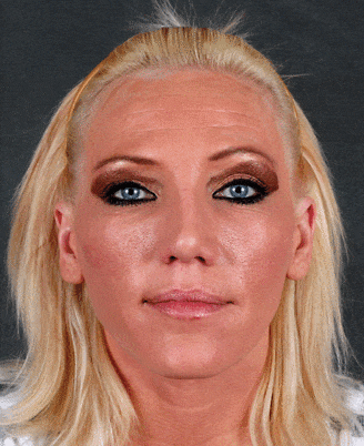rhinoplasty - patient 5857 - after 1 rhinoplasty - patient 5857 - after 1