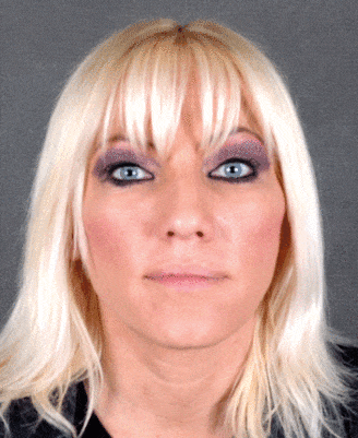 rhinoplasty - patient 5857 - before 1 rhinoplasty - patient 5857 - before 1