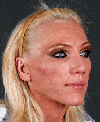 rhinoplasty - patient 5857 - after 2 rhinoplasty - patient 5857 - after 2