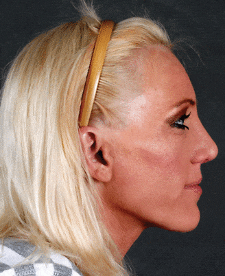 rhinoplasty - patient 5857 - after 3 rhinoplasty - patient 5857 - after 3
