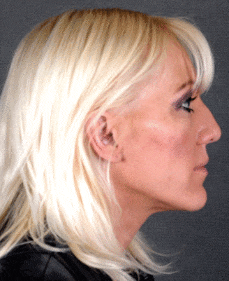 rhinoplasty - patient 5857 - before 3 rhinoplasty - patient 5857 - before 3