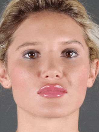 rhinoplasty - patient 5871 - after 1 rhinoplasty - patient 5871 - after 1
