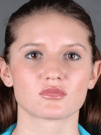 rhinoplasty - patient 5871 - before 1 rhinoplasty - patient 5871 - before 1
