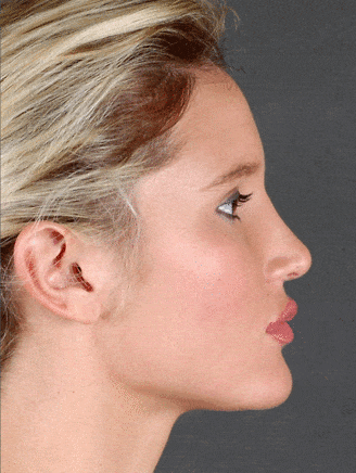 rhinoplasty - patient 5871 - after 2 rhinoplasty - patient 5871 - after 2