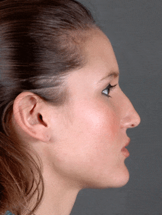 rhinoplasty - patient 5871 - before 2 rhinoplasty - patient 5871 - before 2