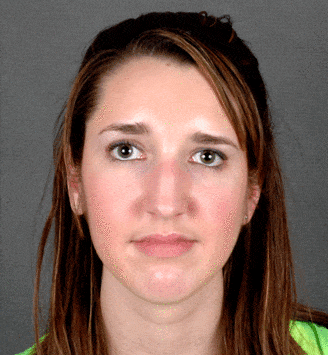 rhinoplasty - patient 5944 - before 1 rhinoplasty - patient 5944 - before 1