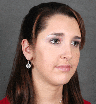 rhinoplasty - patient 5944 - after 2 rhinoplasty - patient 5944 - after 2