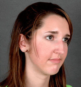 rhinoplasty - patient 5944 - before 2 rhinoplasty - patient 5944 - before 2