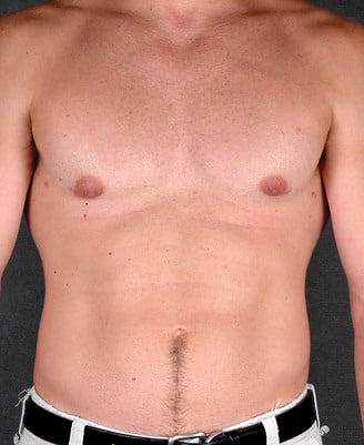 gynecomastia - patient 6048 - after 1 gynecomastia - patient 6048 - after 1