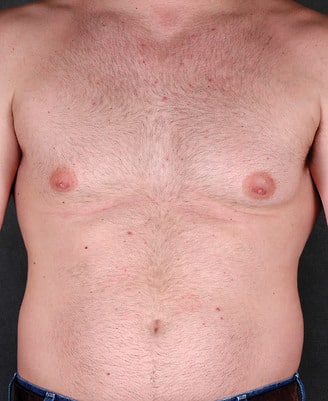 gynecomastia - patient 6048 - before 1 gynecomastia - patient 6048 - before 1