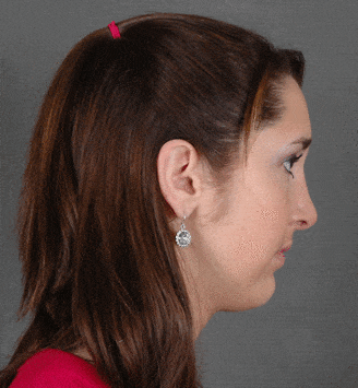 rhinoplasty - patient 5944 - after 3 rhinoplasty - patient 5944 - after 3