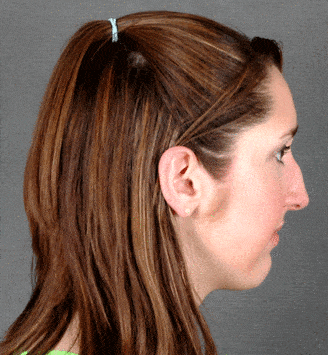 rhinoplasty - patient 5944 - before 3 rhinoplasty - patient 5944 - before 3