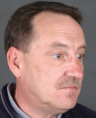 rhinoplasty - patient 5890 - after 2 rhinoplasty - patient 5890 - after 2