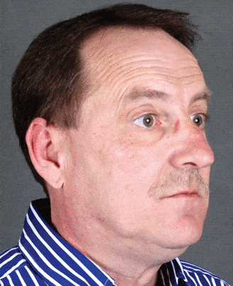 rhinoplasty - patient 5890 - before 2 rhinoplasty - patient 5890 - before 2