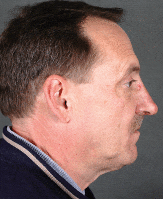 rhinoplasty - patient 5890 - after 3 rhinoplasty - patient 5890 - after 3