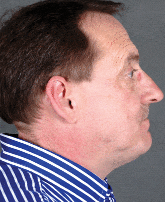 rhinoplasty - patient 5890 - before 3 rhinoplasty - patient 5890 - before 3