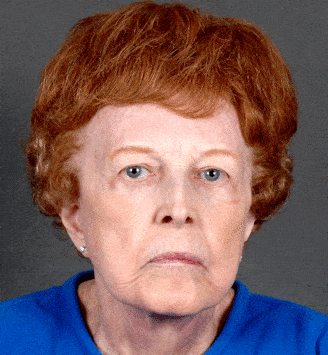 blepharoplasty - patient 5257 - after 1 blepharoplasty - patient 5257 - after 1