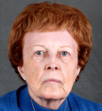 blepharoplasty - patient 5257 - before 1 blepharoplasty - patient 5257 - before 1