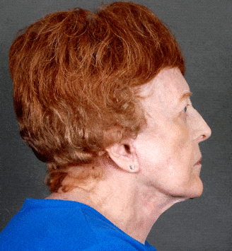 blepharoplasty - patient 5257 - after 2 blepharoplasty - patient 5257 - after 2