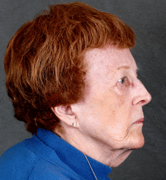 blepharoplasty - patient 5257 - before 2 blepharoplasty - patient 5257 - before 2