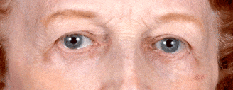 blepharoplasty - patient 5257 - after 3 blepharoplasty - patient 5257 - after 3