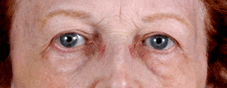 blepharoplasty - patient 5257 - before 3 blepharoplasty - patient 5257 - before 3