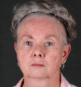 obagi skin care - patient 6104 - before 1 obagi skin care - patient 6104 - before 1