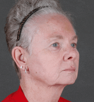 obagi skin care - patient 6104 - after 2 obagi skin care - patient 6104 - after 2