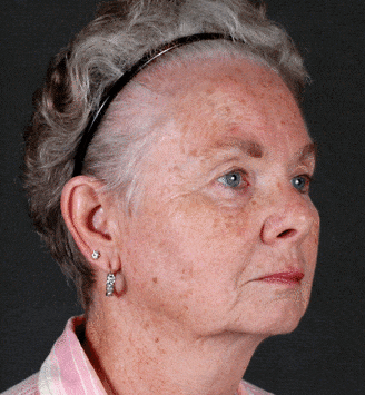 obagi skin care - patient 6104 - before 2 obagi skin care - patient 6104 - before 2