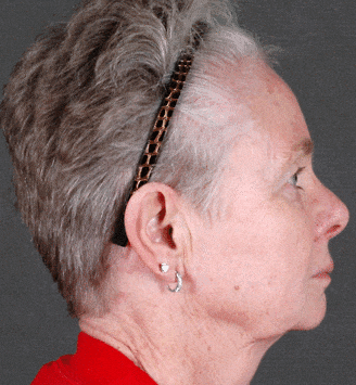 obagi skin care - patient 6104 - after 3 obagi skin care - patient 6104 - after 3