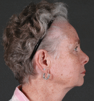 obagi skin care - patient 6104 - before 3 obagi skin care - patient 6104 - before 3