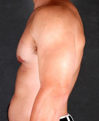 gynecomastia - patient 6048 - after 2 gynecomastia - patient 6048 - after 2