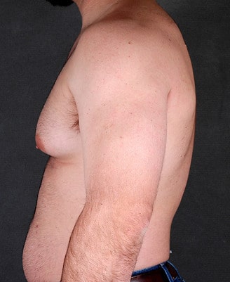 gynecomastia - patient 6048 - before 2 gynecomastia - patient 6048 - before 2