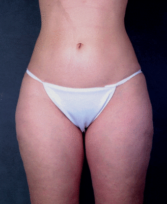 liposuction - patient 4276 - before 1 liposuction - patient 4276 - before 1